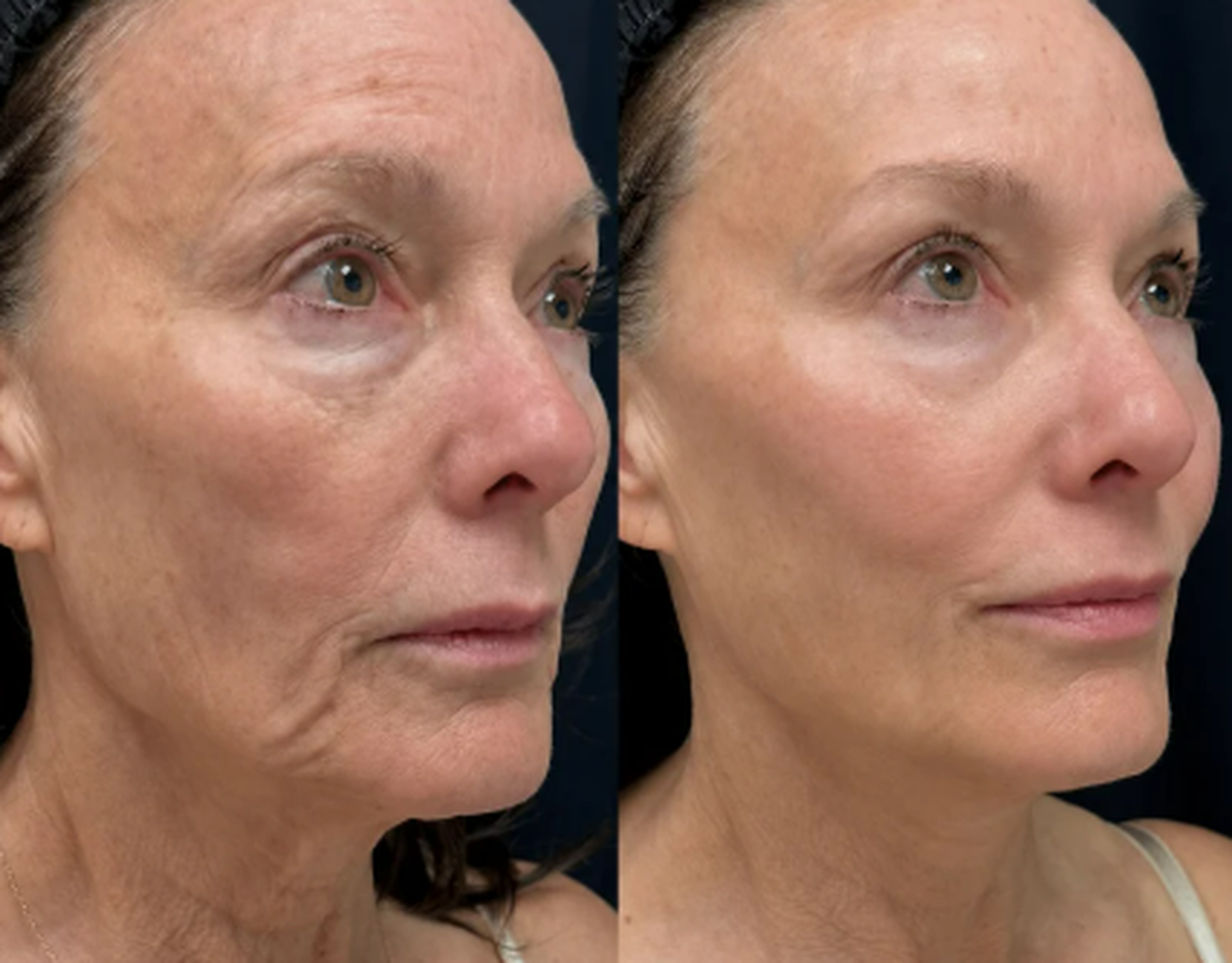 Face and neck treatment before and after result 6