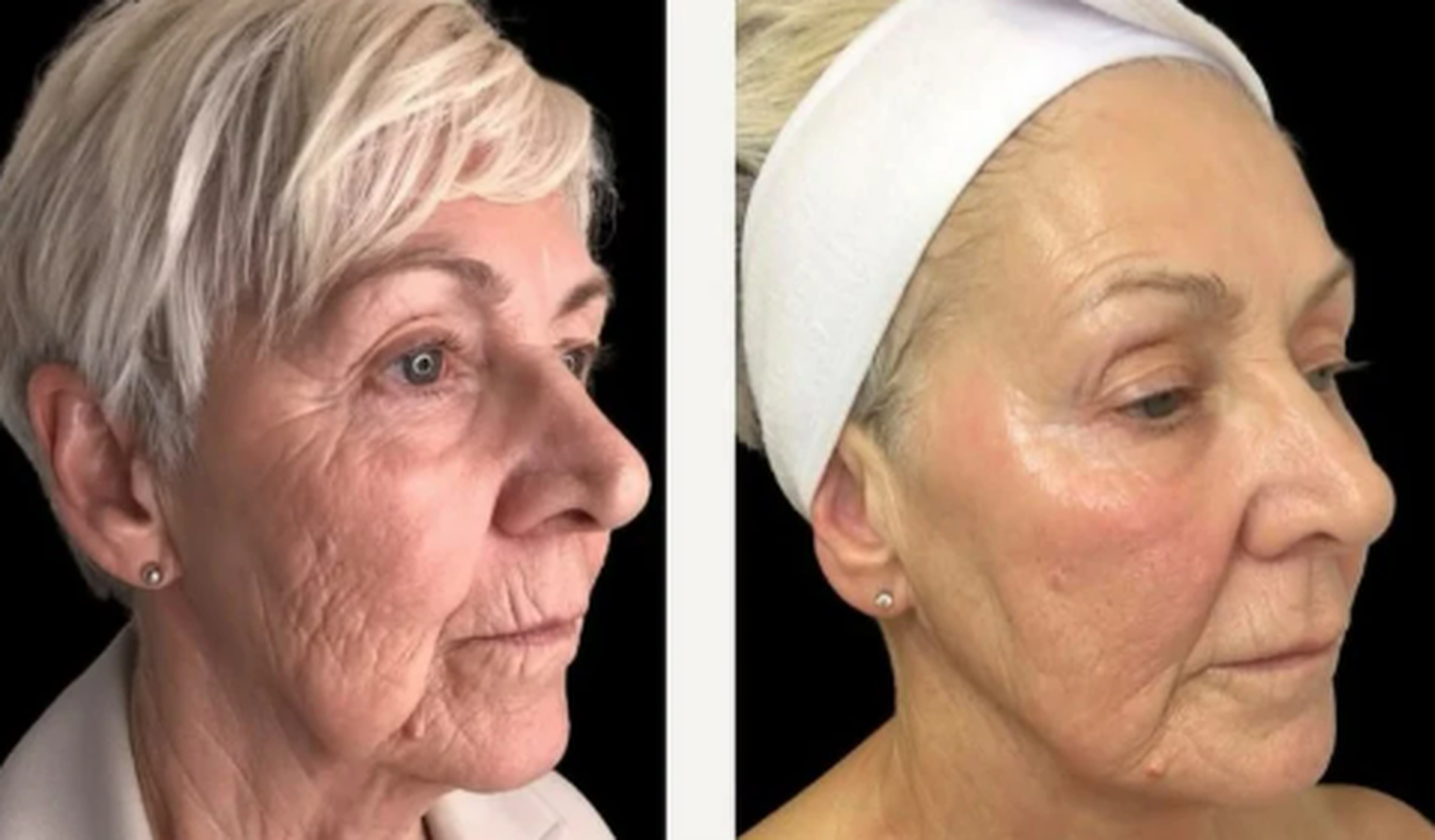 Face and neck treatment before and after result 4
