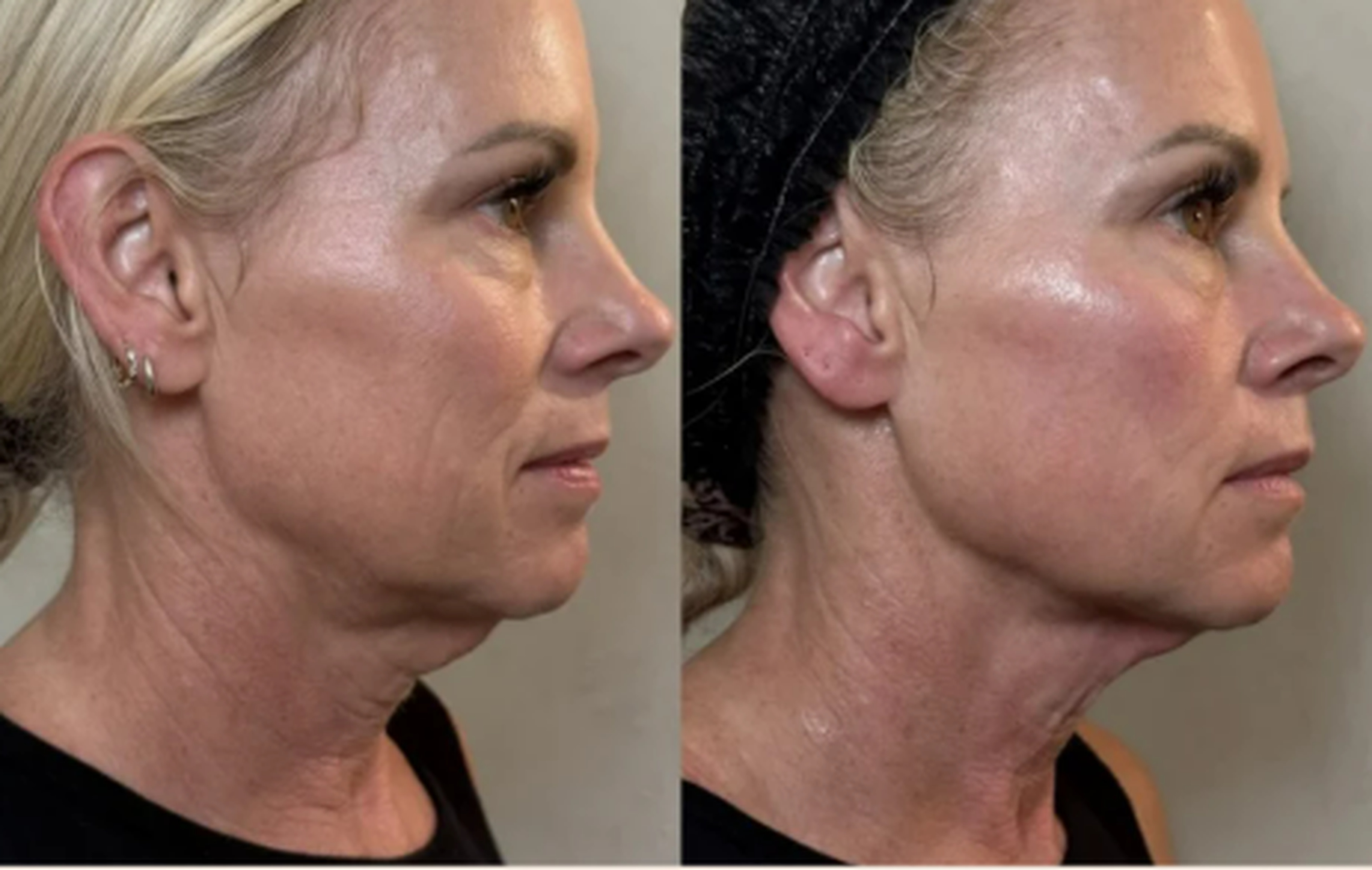 Face and neck treatment before and after result 3