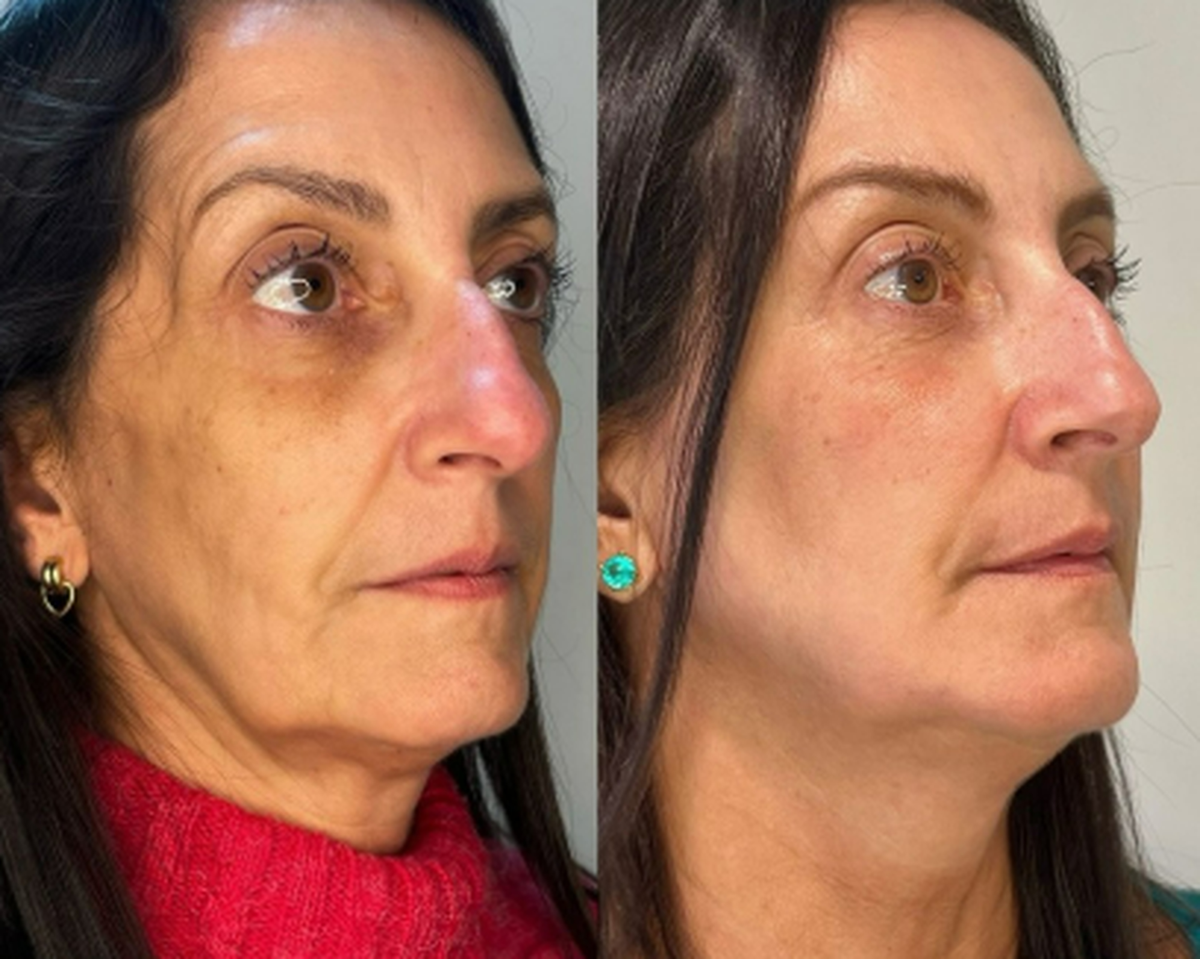 Face and neck treatment before and after result 2