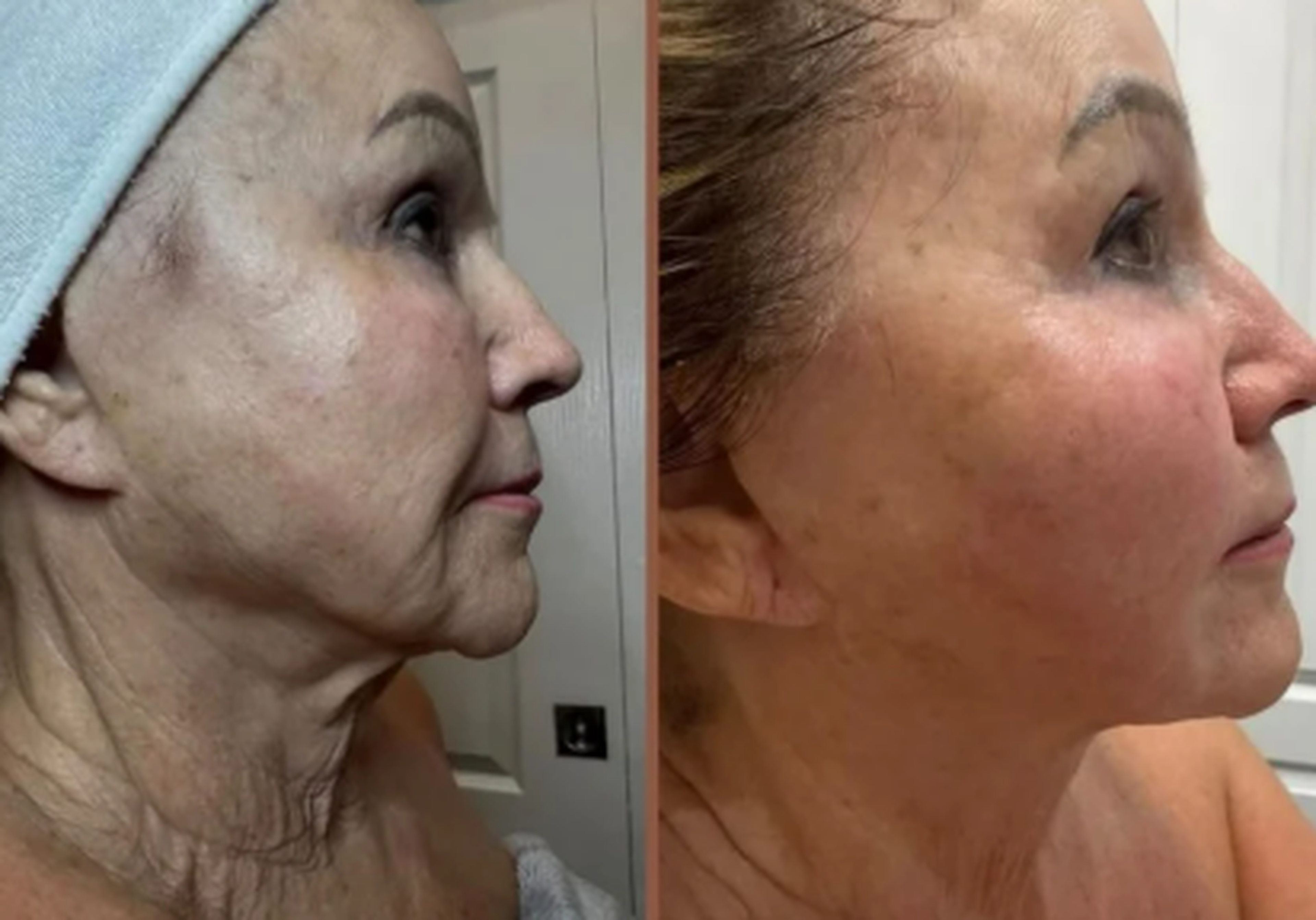 Face and neck treatment before and after result 5