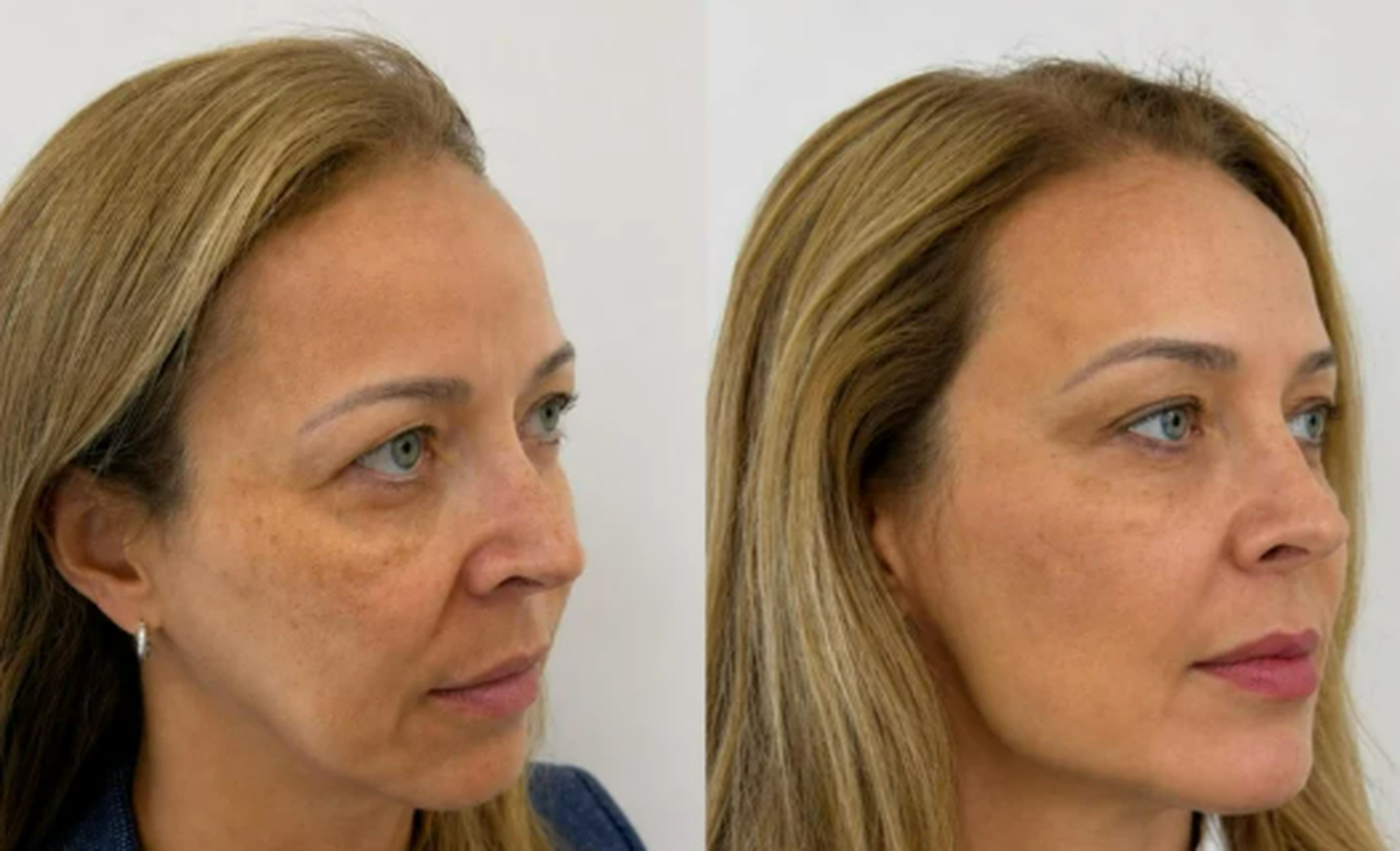 Face and neck treatment before and after result 1